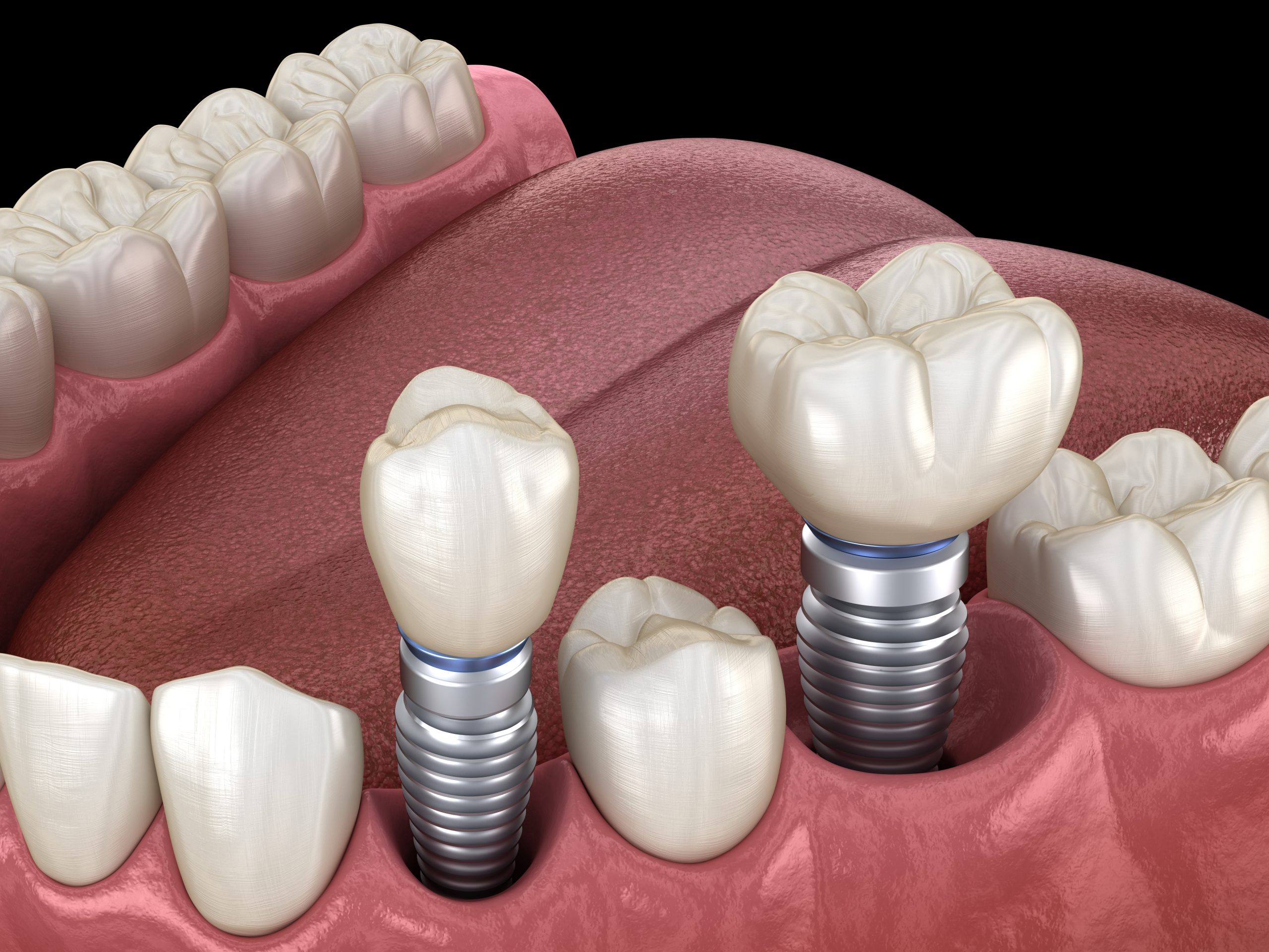 Arlington Heights Dental Crowns Arlington Heights Dental Crowns